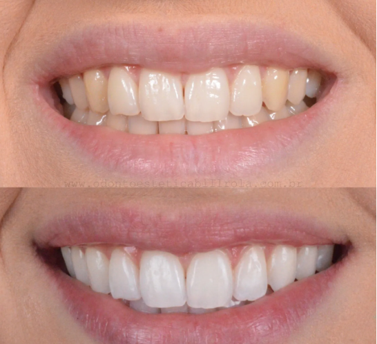 Antes e depois do clareamento dental com Fita Roxa RX3